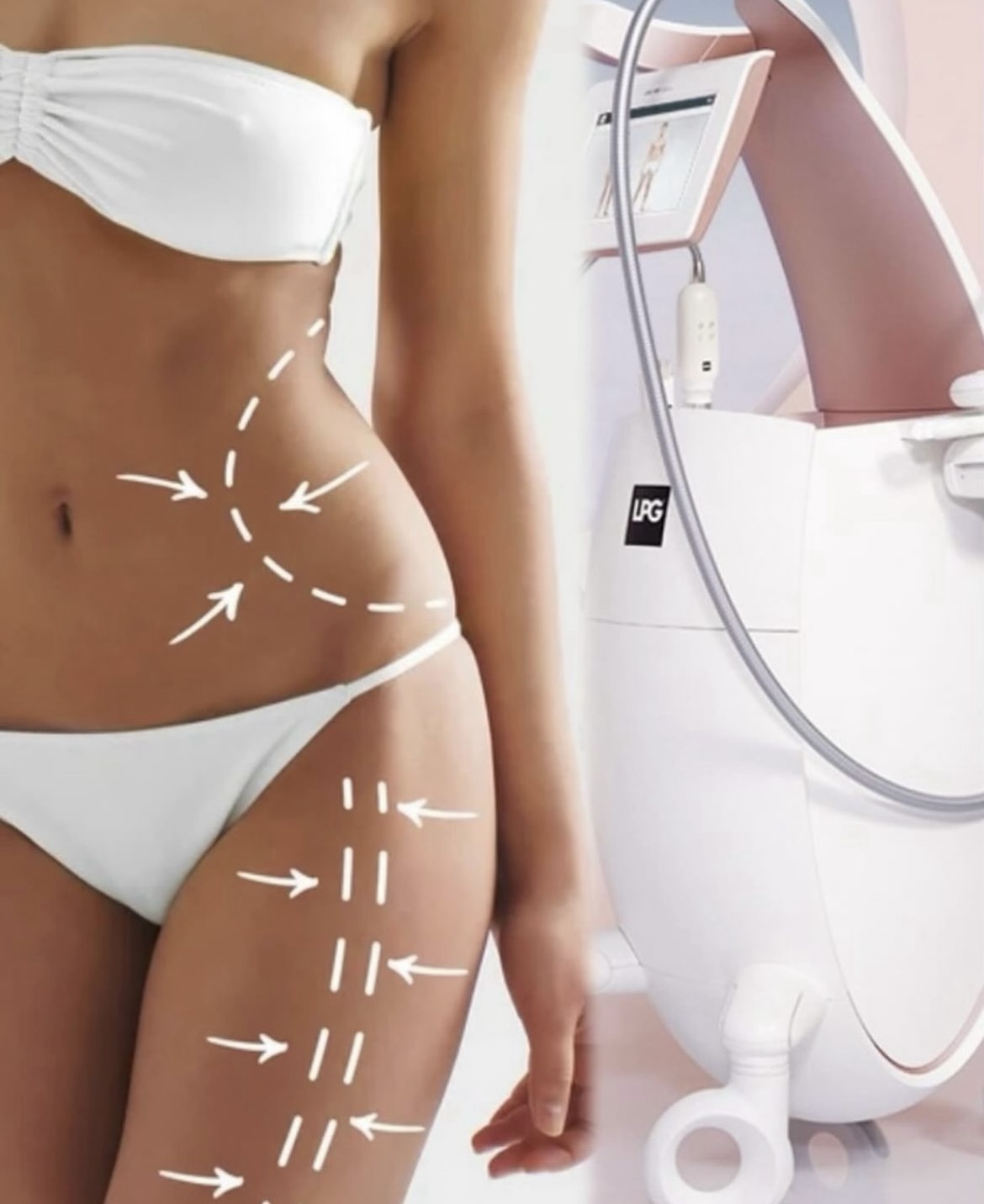 LPG®  Endermologie   prevratná technologická inovácia 